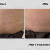 Say Goodbye to Unwanted Hair with Laser Precision