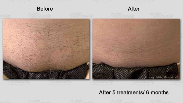 Say Goodbye to Unwanted Hair with Laser Precision