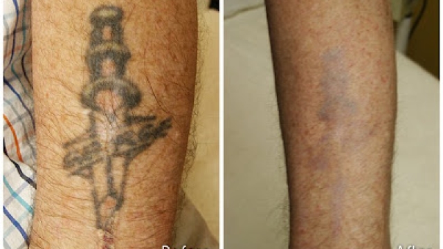 Tattoo Removal – Are You Aware Of This Understanding?