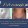 Flat and Fabulous: Unveiling the Benefits of Abdominoplasty