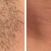 Laser Hair Removal: Smooth, Silky and Carefree!