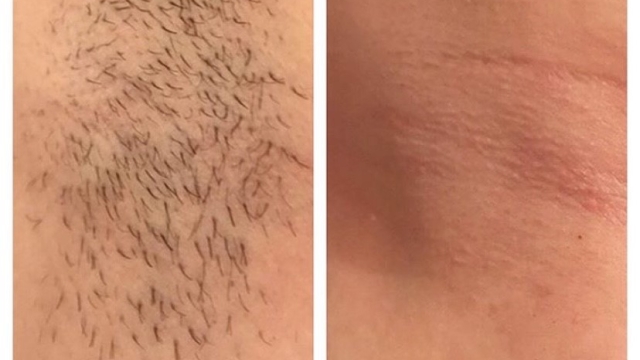 Laser Hair Removal: Smooth, Silky and Carefree!