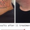 Tca Tattoo Removal – Ideal For Removing Leg Tattoos