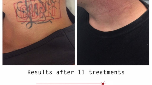 Tca Tattoo Removal – Ideal For Removing Leg Tattoos