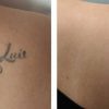 The Pros And Cons Of Laser Tattoo Removal