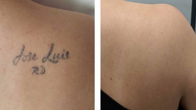 The Pros And Cons Of Laser Tattoo Removal