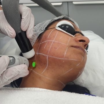激光脱毛：告别毛发烦恼的神奇之道