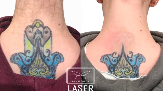 Tattoo Removal Costs – Finding A Cost-Effective Way To Obtain Rid Of Your Tattoo