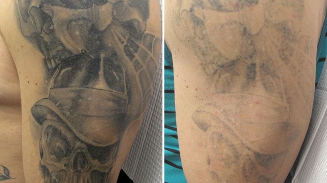 Wrecking Balm Tattoo Removal Cream Guide