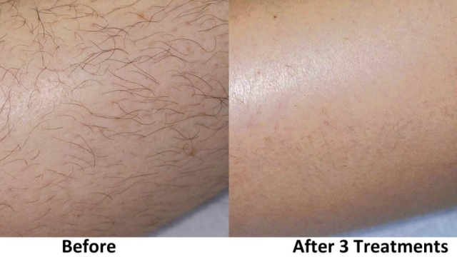 Say Goodbye to Unwanted Hair: Unlocking the Power of Laser Hair Removal