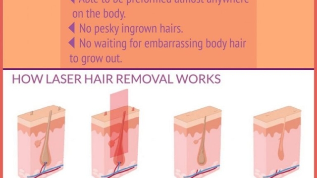 Laser Hair Removal: A Permanent Solution to Unwanted Hair